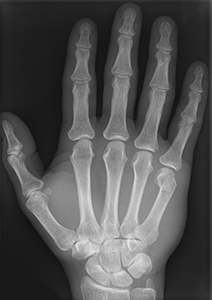 Ilustracja przedstawia czarno-białe zdjęcie rentgenowskie dłoni. Doskonale widoczne szczegóły budowy kości.