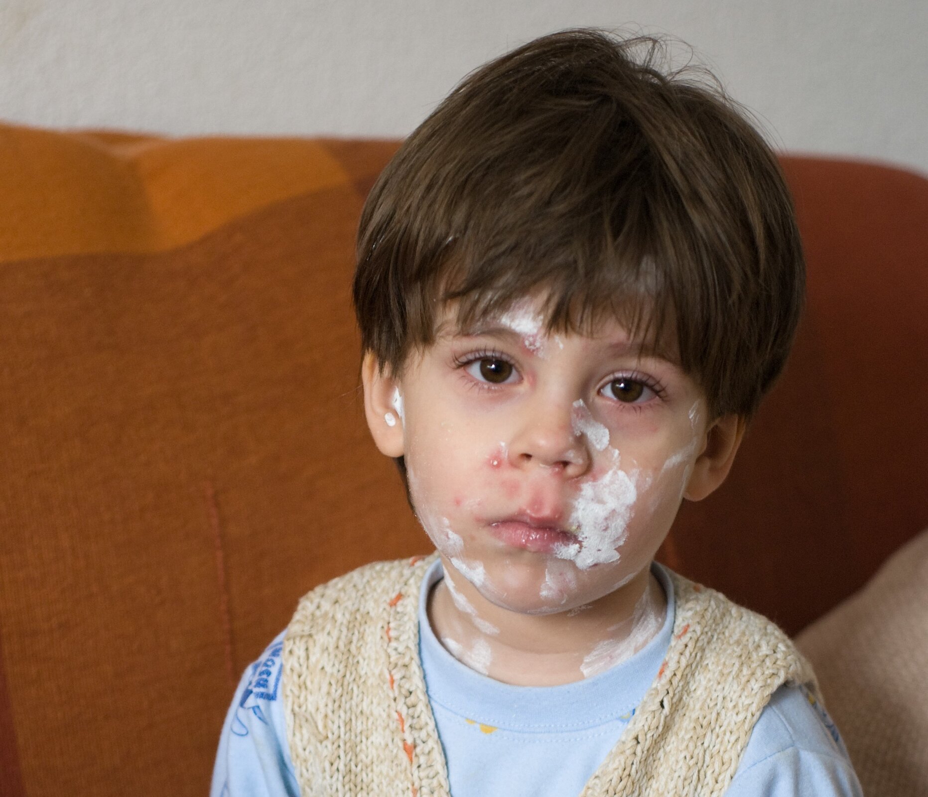Zdjęcie przedstawia dziecko przechodzące ospę. Część jego twarzy pokryta jest białym kremem.