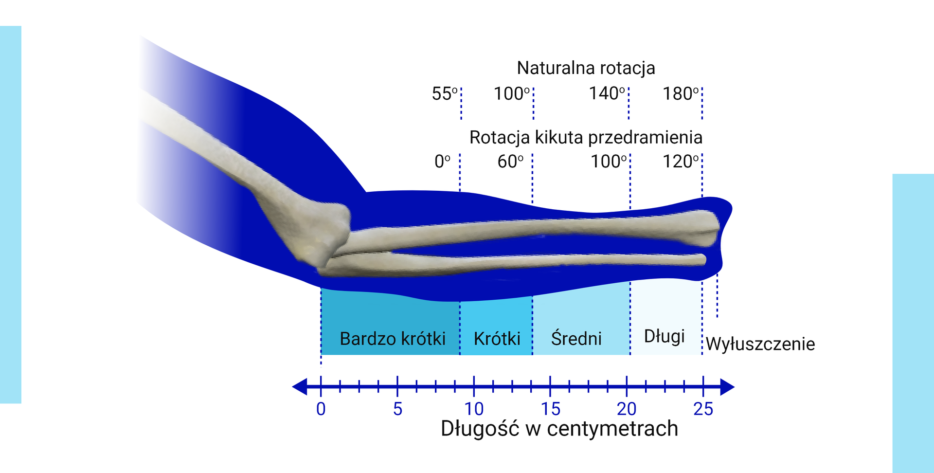 Grafika przedstawia poziomy amputacji w obrębie przedramienia o przykładowej długości dwudziestu pięciu centymetrów. Na rycinie oznaczono orientacyjną długość kikutów i ich możliwości rotacyjne. Bardzo krótki kikut charakteryzuje się długością do dziewięciu centymetrów oraz brakiem rotacji, podczas gdy normalna rotacja wynosi pięćdziesiąt pięć stopni. Kikut krótki charakteryzuje się długością od dziewięciu do czternastu centymetrów i rotacją sześćdziesięciu stopni; normalna rotacja to sto stopni. Kikut średni charakteryzuje się długością od czternastu do dwudziestu centymetrów oraz rotacją stu stopni; normalna rotacja to sto czterdzieści stopni. Kikut długi charakteryzuje się długością od dwudziestu do dwudziestu pięciu centymetrów oraz rotacją stu dwudziestu stopni, podczas gdy normalna rotacja to sto osiemdziesiąt stopni.
