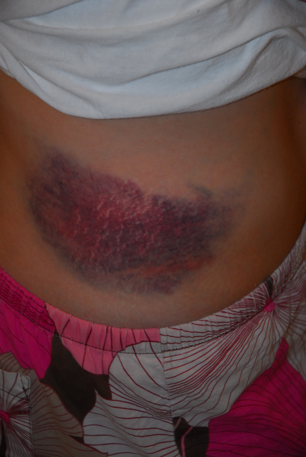 Fotografia stłuczenia. Na brzuchu ciemna, czerwono‑fioletowa plama.