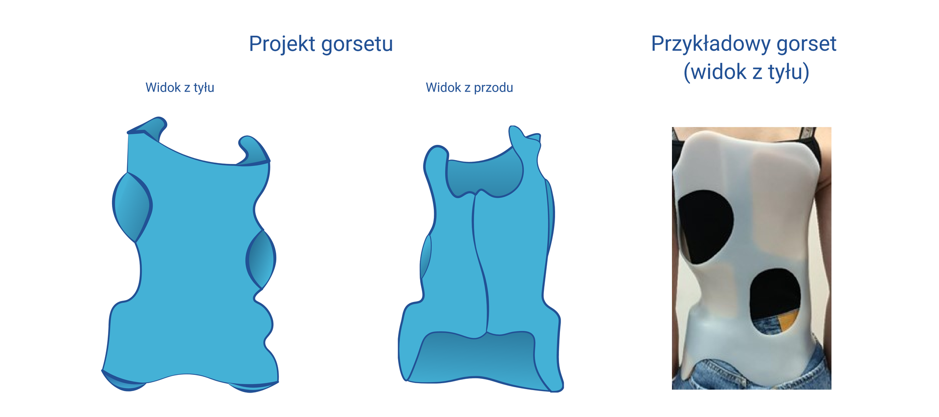 Grafika przedstawiająca schemat gorsetu z przodu i z tyłu. Gorset obejmuje większość tułowia. Na rycinie zamieszczono również zdjęcie pacjentki z założonym przykładowym gorsetem z tworzywa sztucznego w widoku z tyłu.
