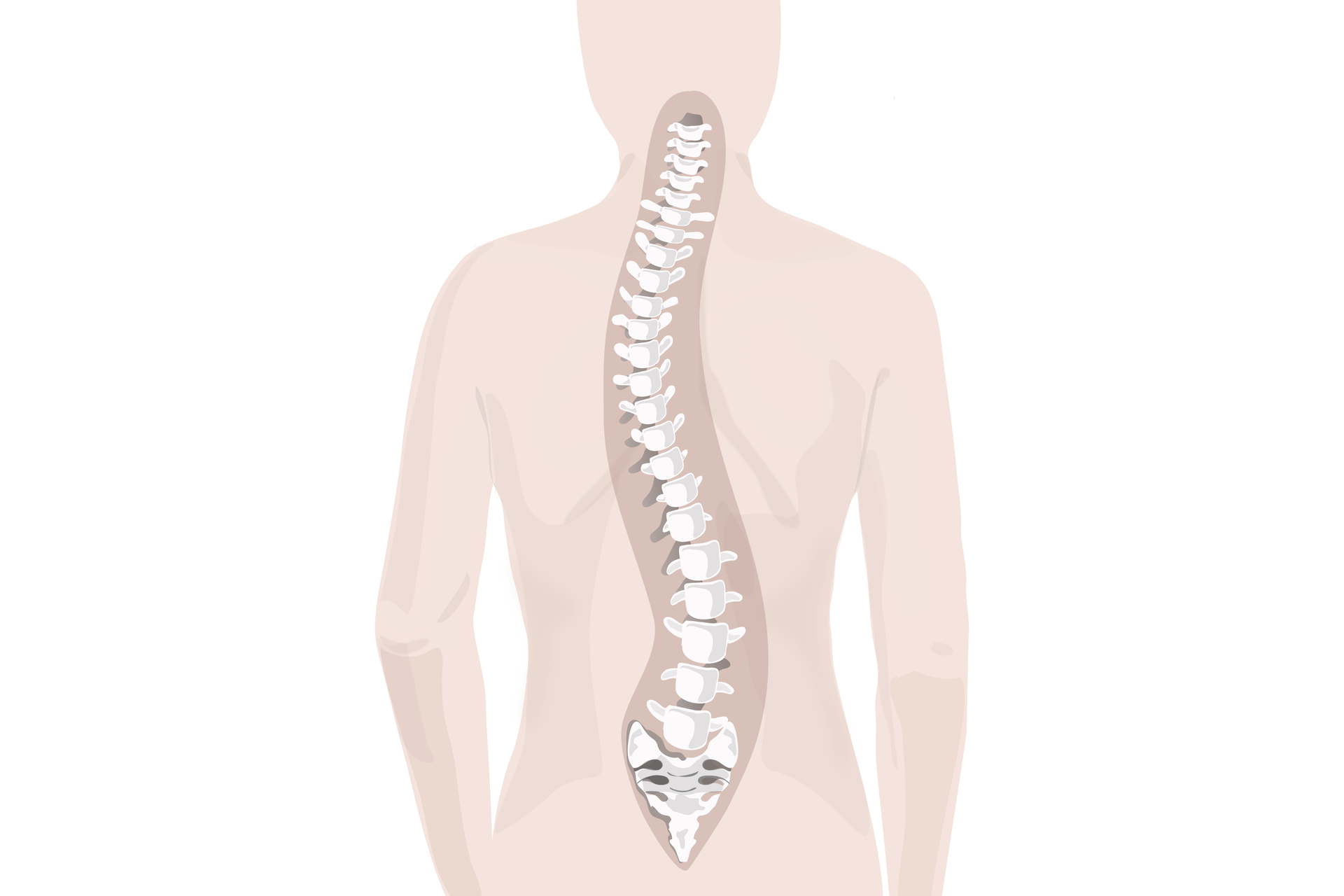 Ilustracja przedstawia odwróconą postać, u której uwidoczniony jest kręgosłup, który jest bocznie skrzywiony.