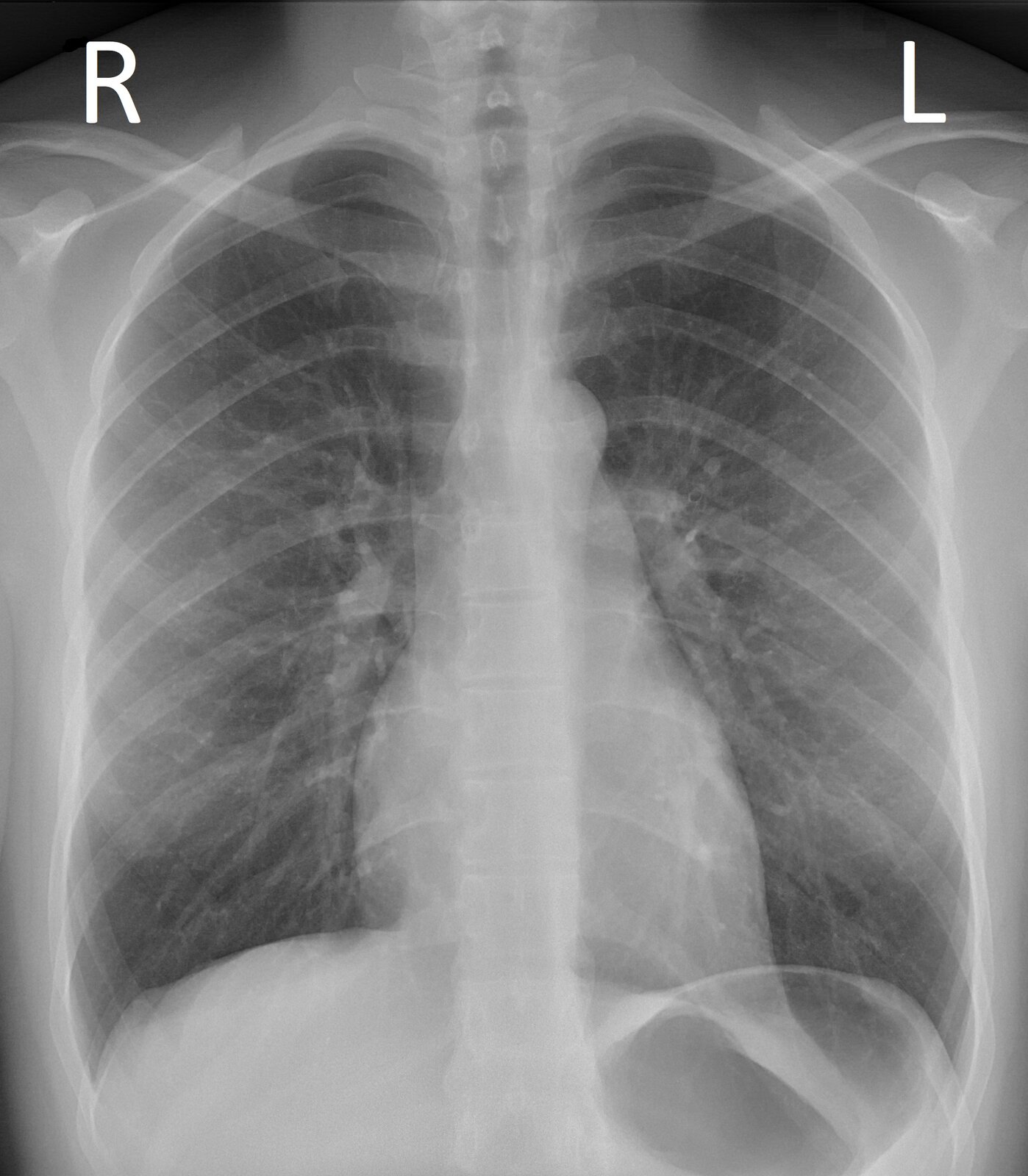 Grafika przedstawia radiogram klatki piersiowej. Widoczne są ciemne kontury płuc i żebra oraz obojczyki, na górze widnieją duże litery R i L symbolizujące stronę prawą i lewą. 