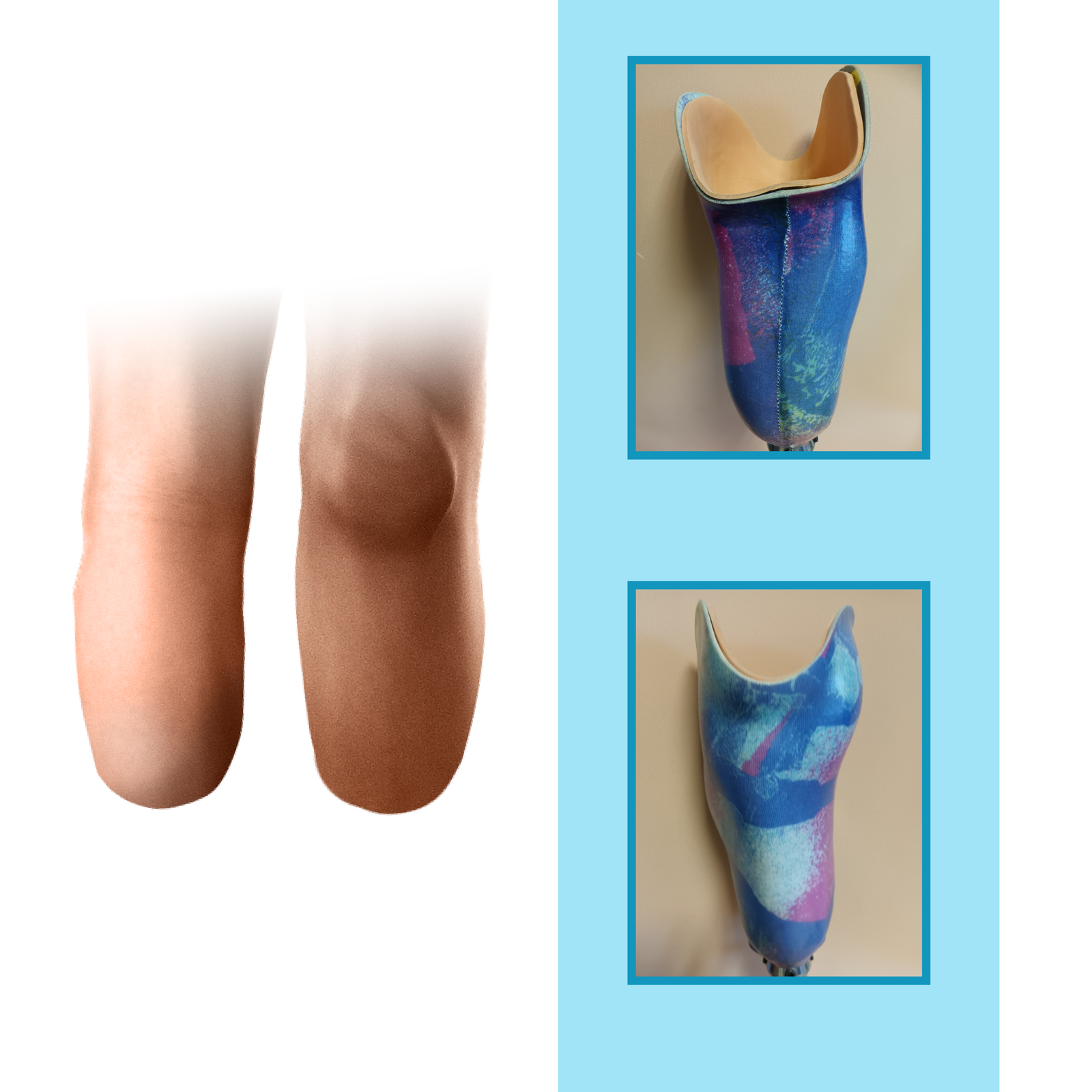 Grafika przedstawia średniej długości kikut podudzia w widoku z przodu i z tyłu. Na rycinie zamieszczono również zdjęcia leja typu PTB w widoku z przodu i z tyłu. Lej został wykonany z kolorowego tworzywa sztucznego.