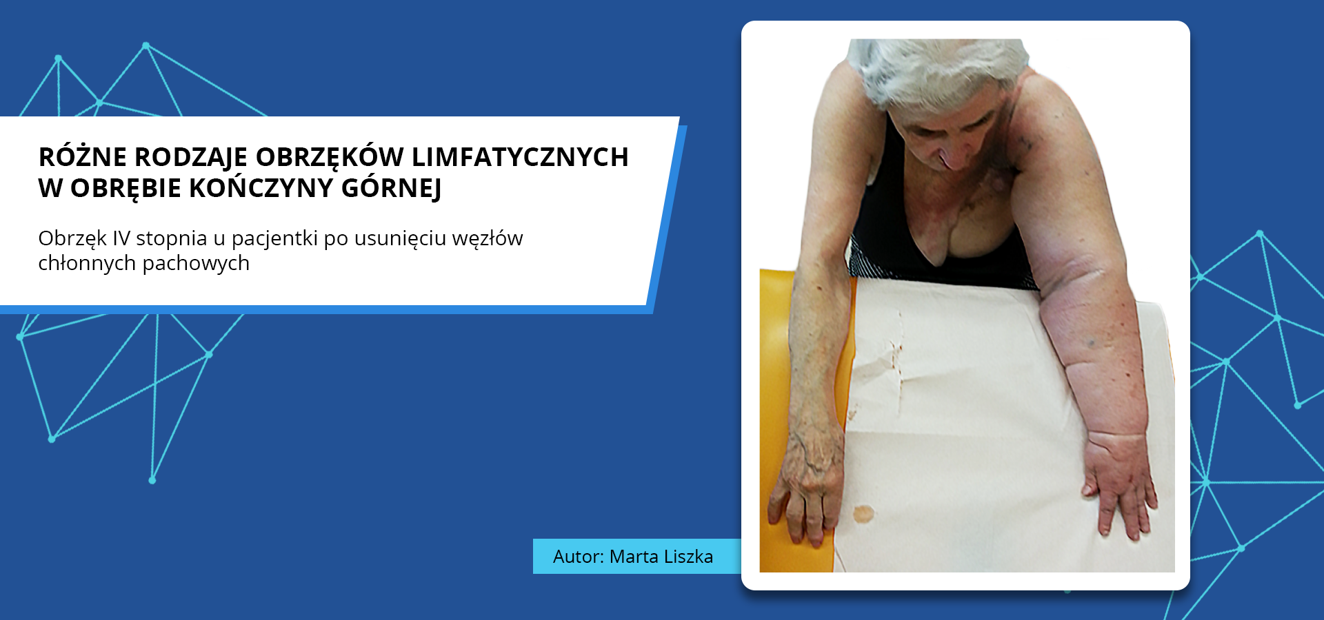 Zdjęcie o tytule różne rodzaje obrzęków limfatycznych w obrębie kończyny górnej. Obrzęk czwartego stopnia u pacjentki po usunięciu węzłów chłonnych pachowych. Zdjęcie przedstawia starszą pacjentkę z obiema kończynami górnymi wyprostowanymi na kozetce lekarskiej. Lewa kończyna górna jest opuchnięta i powiększona na całej długości oraz wyraźnie zaczerwieniona. Autorka zdjęcia: Marta Liszka.