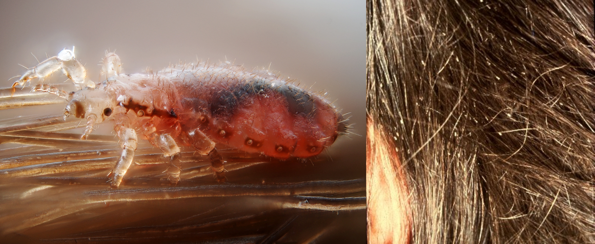 Dwa zdjęcia. Na pierwszym zdjęciu wesz głowowa, owad bezskrzydły, półprzezroczysty, posiadający spłaszczony, owalny tułów i krótkie odnóża. Na drugim zdjęciu gnidy przyczepione do włosów.