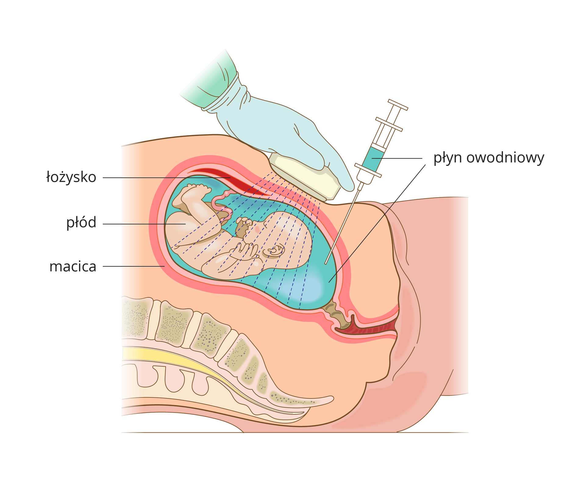 Ilustracja przedstawia przekrój podłużny przez ciężarną kobietę. Widoczne są: płód, łożysko i macica. Powłoki brzuszne i macica nakłute są cienką igłą, do strzykawki pobierany jest płyn owodniowy. Zabieg odbywa się pod kontrolą USG.