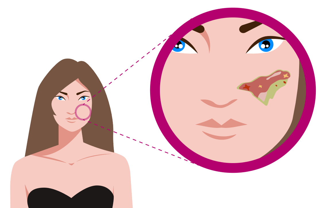 Grafika przedstawia kobietę wraz ze zbliżeniem na twarz. Na skórze twarzy obok nosa i pod okiem widoczne miejsce poparzenia powstałego po działaniu kwasów stężonych.