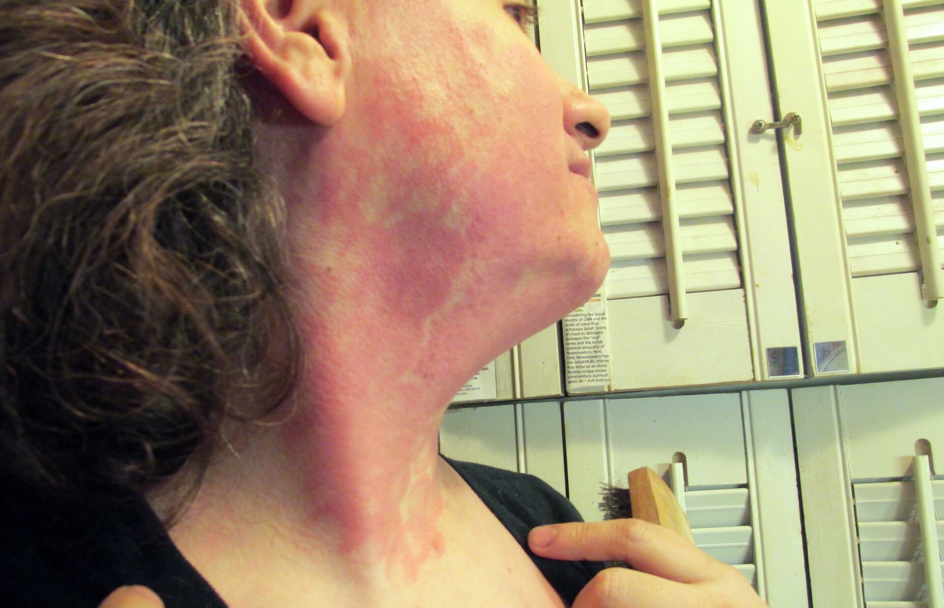 Zdjęcie przedstawia zbliżenie na twarz kobiety. Skóra na twarzy i szyi jest zaczerwieniona od poparzenia laserowego po zastosowaniu błędnie ustalonych dawek i parametrów.