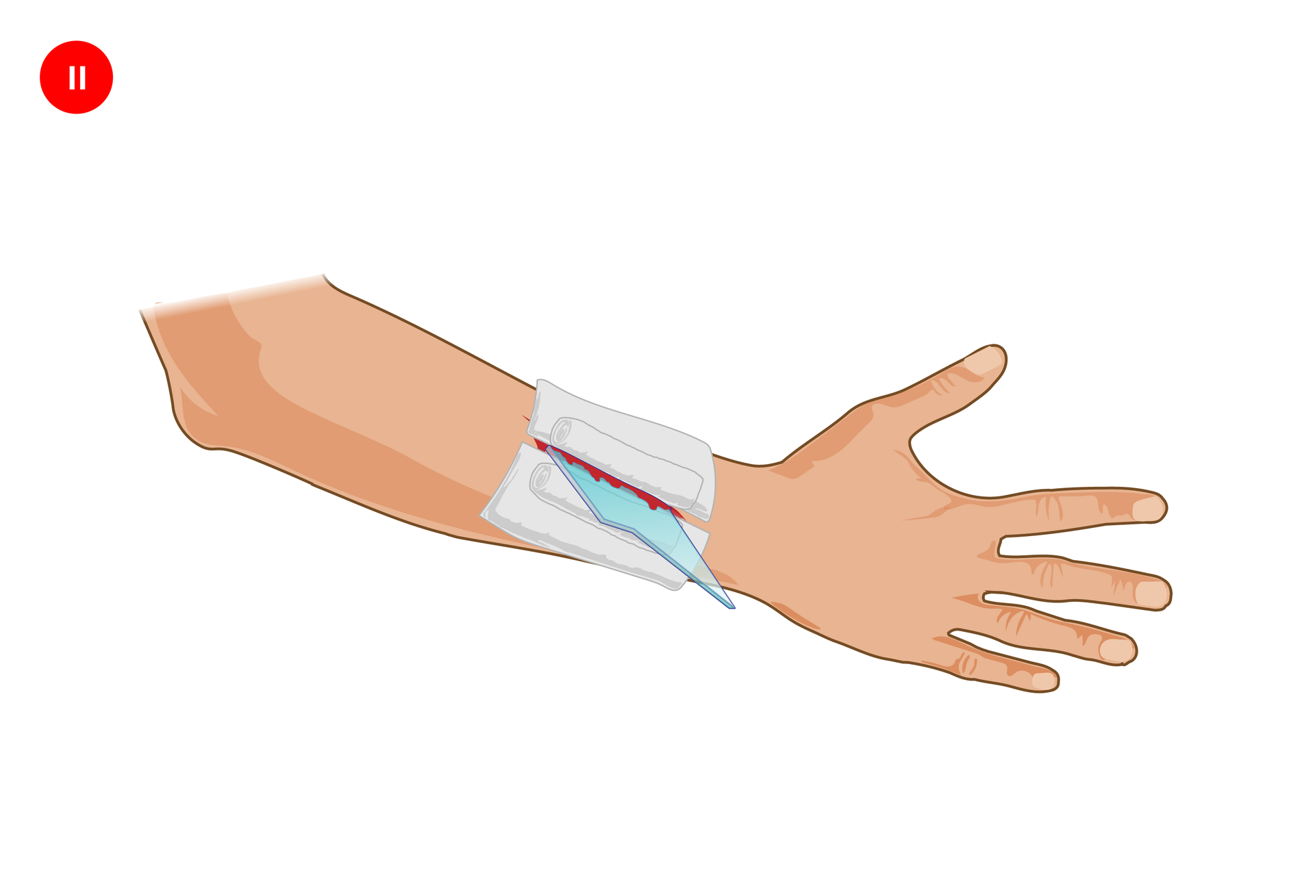 Ilustracja prezentująca sposób opatrywania rany z ciałem obcym. Prawa ręka skierowana zewnętrzną stroną do obserwatora, z wyprostowanymi palcami po prawej stronie. Po obu stronach kawałka szkła do rany przyłożone są jałowe opatrunki, a samo szkło jest unieruchomione zwiniętymi w rulony dodatkowymi kawałkami gazy lub bandaża umieszczonymi na opatrunkach.