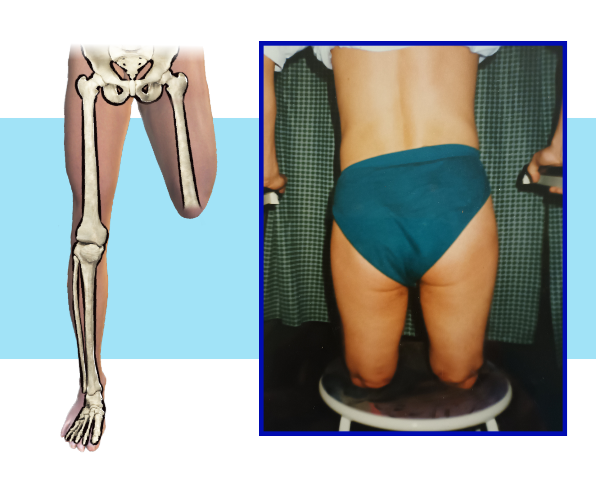 Schemat i zdjęcie kończyn dolnych pacjenta z długim kikutem uda.
