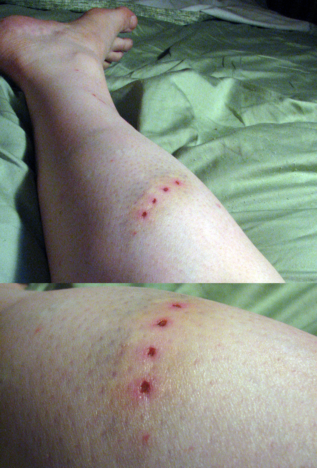 Zdjęcie przedstawia ranę kłutą. Zbliżenie na prawą łydkę osoby poszkodowanej. Pięć czerwonych punktów nakłuć ułożonych w równych odstępach w formie ukośnej linii. Cały obszar zranienia lekko spuchnięty i pokryty brązowiejącym sińcem.