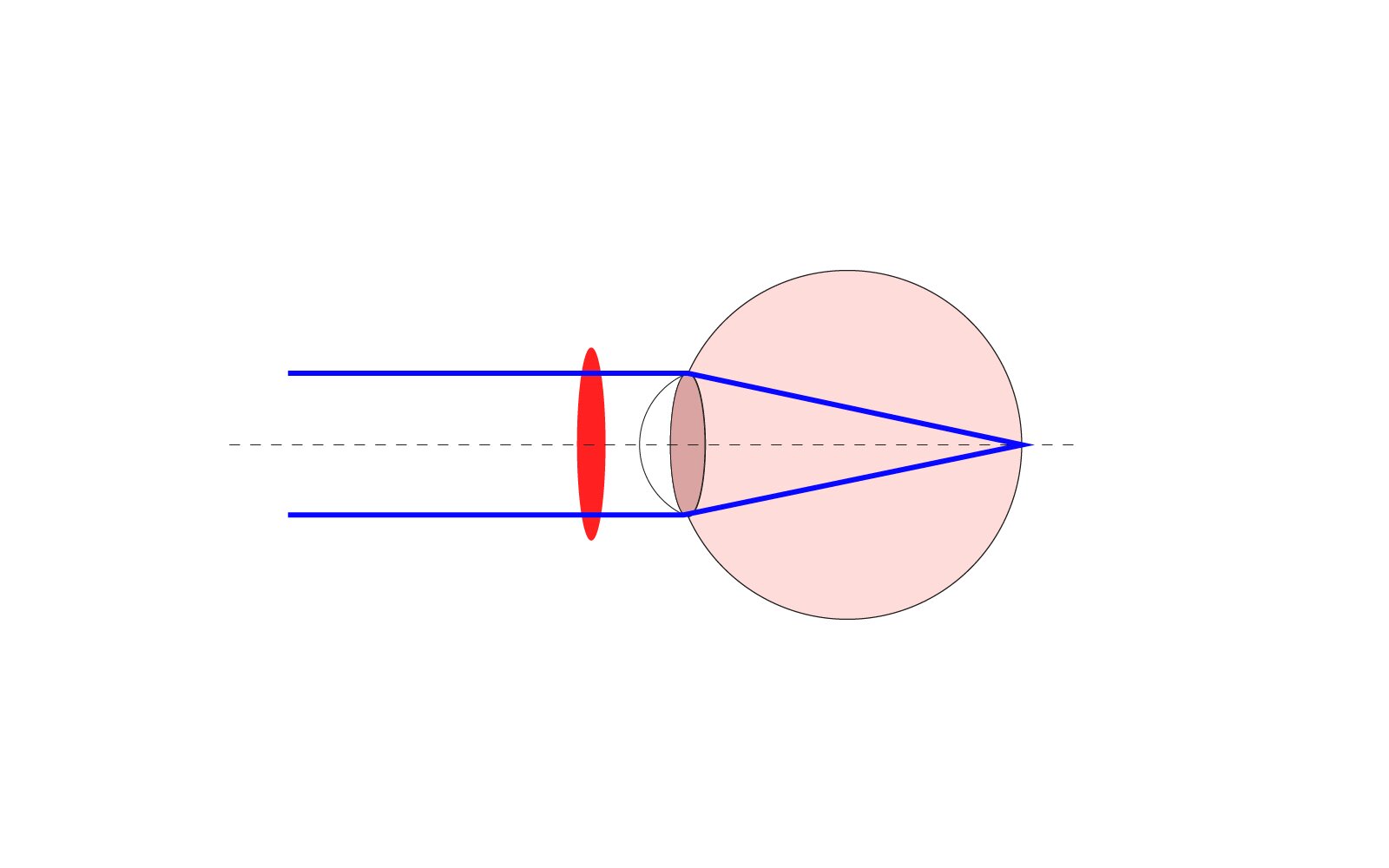 Ilustracja przedstawia Nadwzroczność oka pokazane jest oko oraz nieprawidłowe ogniskowanie światła na siatkówce oka. Za siatkówką znajduję się czerwony okrąg umiejscowiony w liniach ogniskowania obrazu.