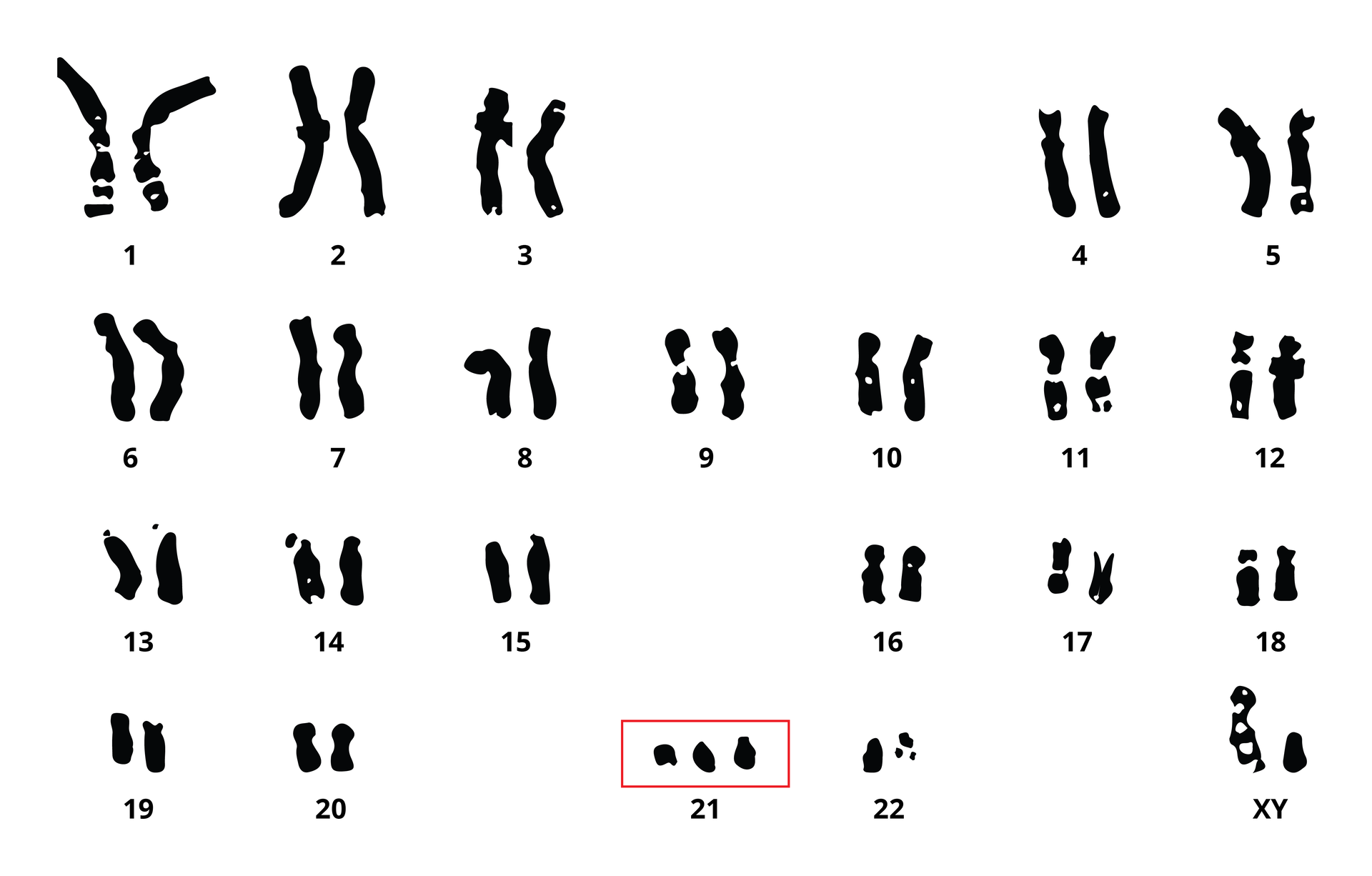 Ilustracja przedstawia zespół chromosomów osoby z zespołem Downa.Wszystkiei chromosomy tworzą pary, za wyjątkiem chromosomów 21, które jest 3. Jest to kariotyp mężczyzny, ostatnia para chromosomów to XY.
