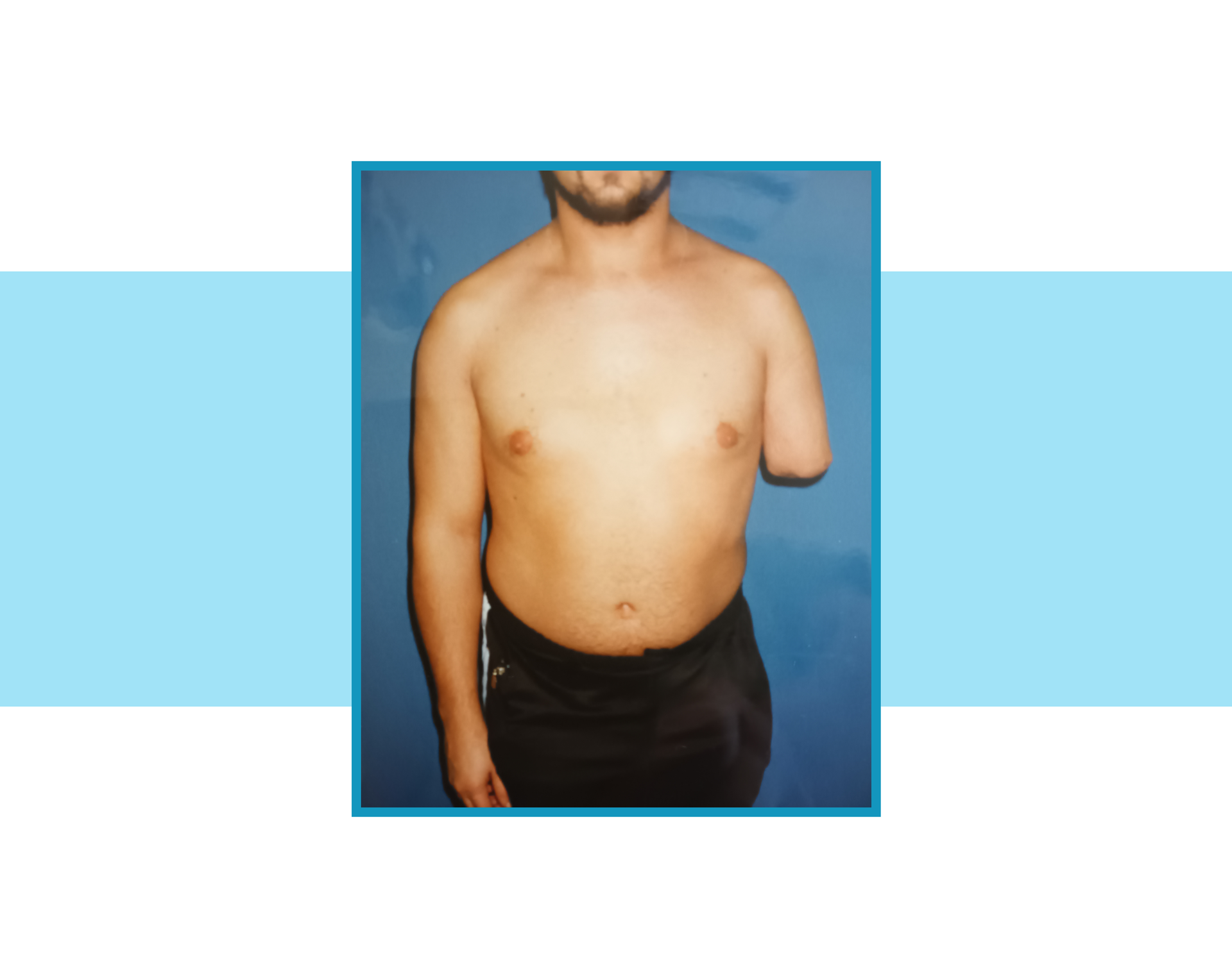 Zdjęcie człowieka ze standardowej długości kikutem lewego ramienia.
