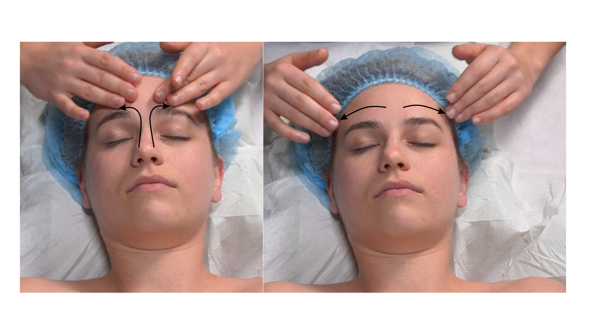 Zdjęcie przedstawia twarz pacjenta w leżeniu tyłem. Głowa pacjenta spoczywa na poduszce. Masażysta znajduje się za głową pacjenta i wykonuje ruch głaskania opuszkami palca wskazującego lub długiego wzdłuż krawędzi nosa obustronnie, a następnie kieruje się ponad linią łuków brwiowych na zewnątrz. Następnie wykonuje ruch głaskania czoła opuszkami palców kierując się od środkowej linii czoła na zewnątrz. 