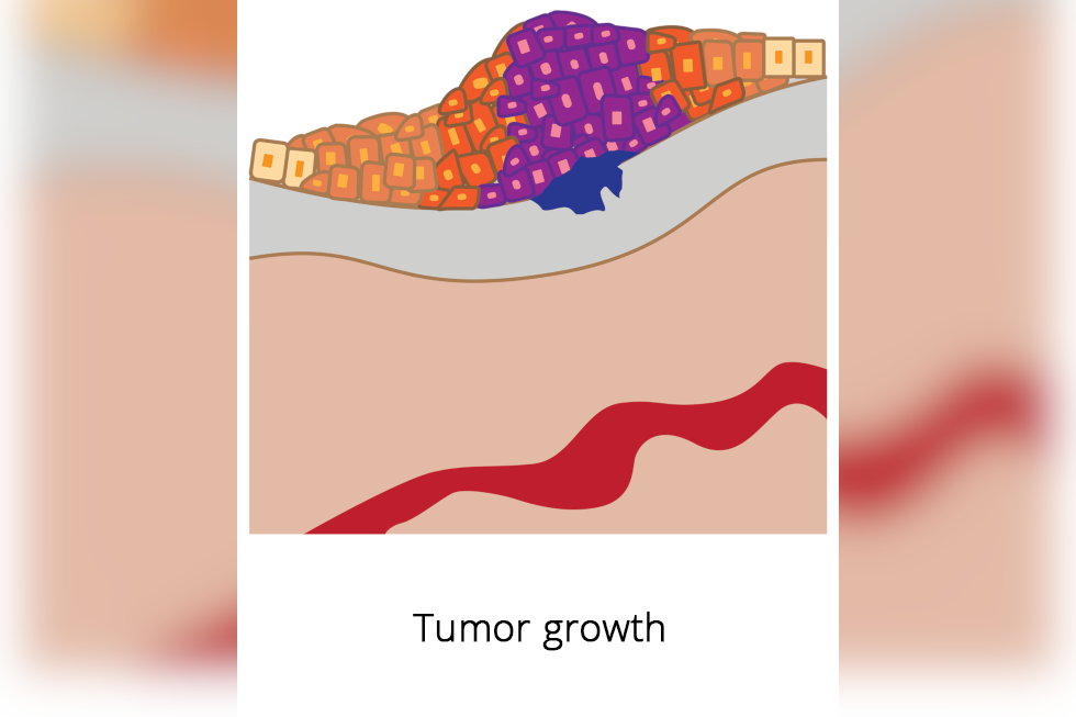 Ilustracja przedstawia większy guz, zmienione komórki występują już w 3 warstwach tkanek. Podpisano: Tumor growth