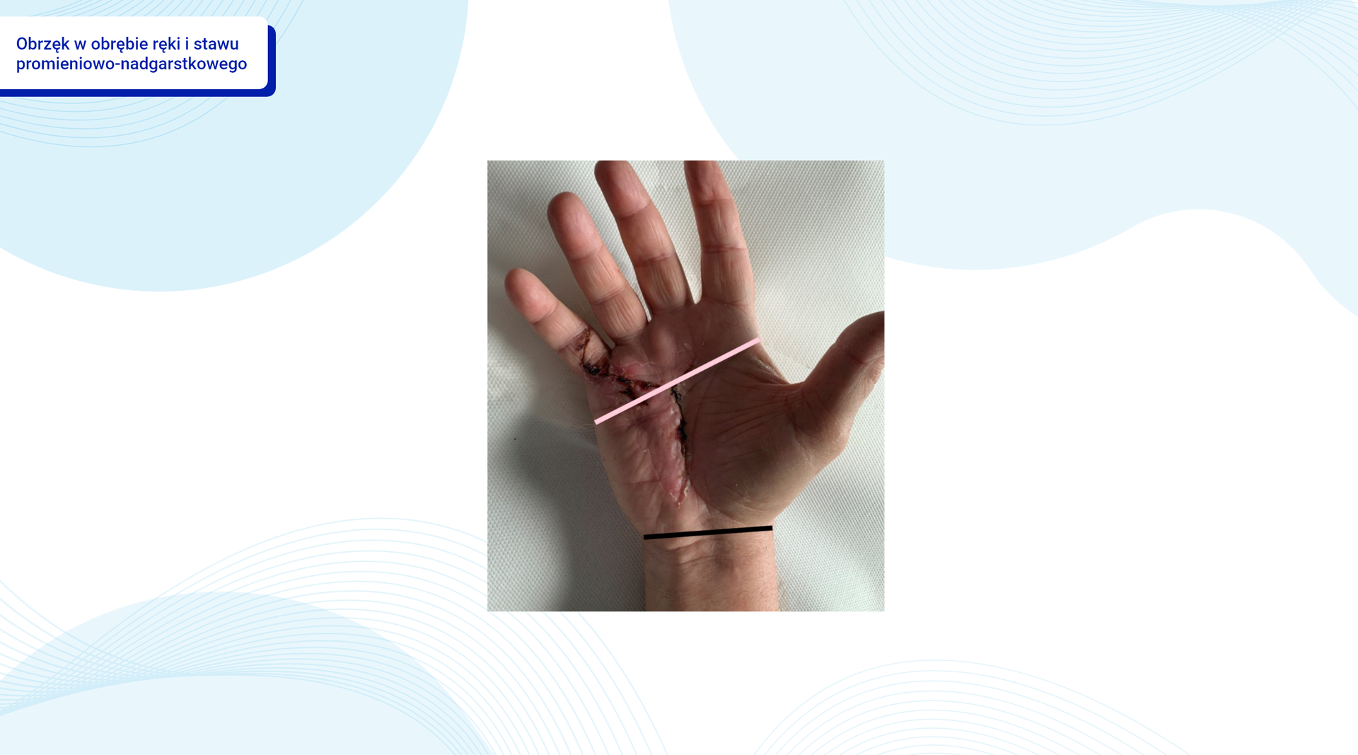Obrzęk w obrębie ręki i stawu promieniowo‑nadgarstkowego
