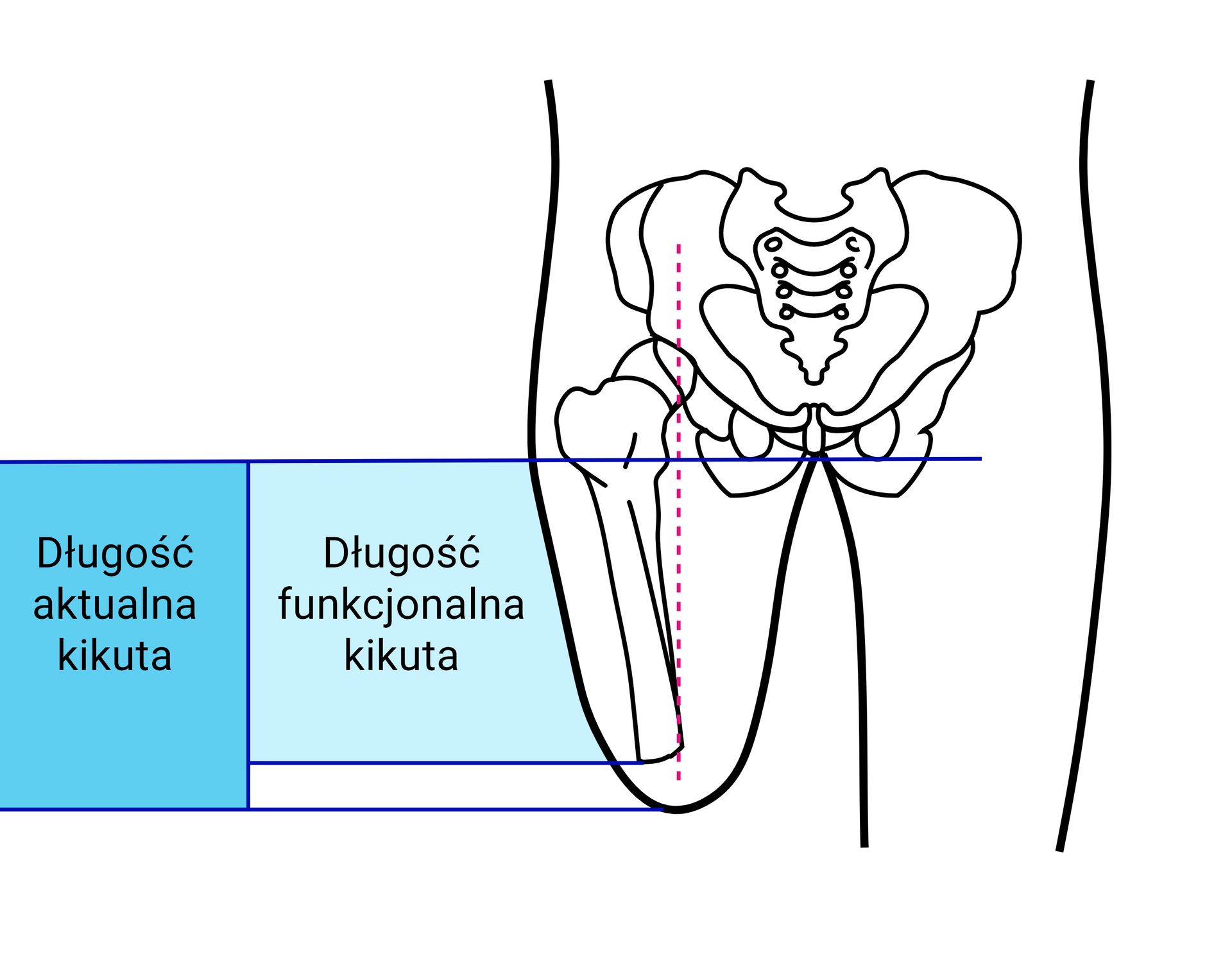 Grafika przedstawia schemat kończyn dolnych wraz ze szkieletem. Jedna z kończyn to kikut. Na rycinie zaznaczono długość aktualną kikuta, czyli długość uwzględniającą tkanki pacjenta poniżej miejsca ucięcia kości, oraz długość funkcjonalną, wyznaczoną przez miejsce ucięcia kości. 