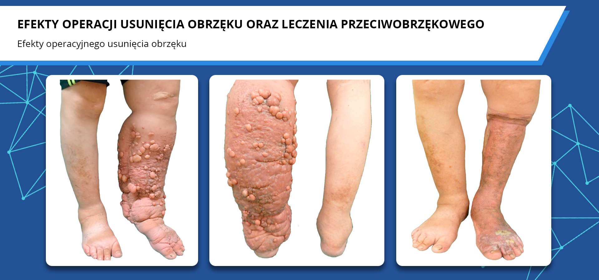 Zdjęcia pod tytułem efekty operacji usunięcia obrzęku oraz leczenia przeciwobrzękowego. Efekty operacyjnego usunięcia obrzęku. Dwa zdjęcia przedstawiają kończynę dolną objętą drastycznym obrzękiem z przodu i z tyłu, bardzo opuchniętą, zaczerwienioną i z wyraźnymi owrzodzeniami. Ostatnie zdjęcie przedstawia tę samą kończynę po usunięciu obrzęku. Kończyna wciąż jest przebarwiona, ale nie występuje już opuchlizna ani owrzodzenia. 