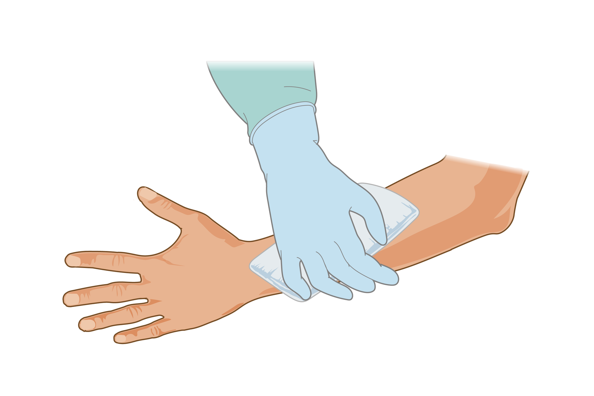 Ilustracja przedstawia zabezpieczanie rany. Lewa ręka ukazana od dłoni z wyprostowanymi palcami po lewej stronie rysunku do łokcia po prawej stronie skierowana jest zewnętrzną stroną do obserwatora. Przemytą już ranę dłoń sanitariusza w gumowej rękawiczce okłada opatrunkiem z gazy. Opatrunek zakrywa całą ranę.