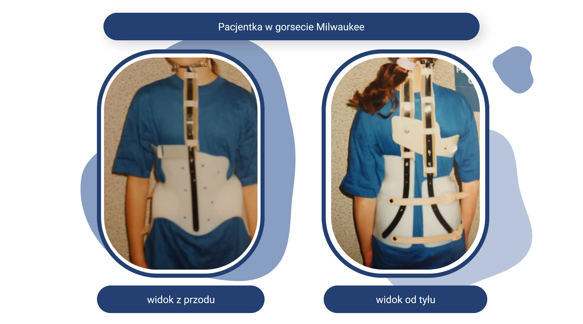 Plansza pod tytułem: Pacjentka w gorsecie Milwaukee. Plansza zawiera dwa zdjęcia z podpisami.
Zdjęcie opisane jako widok z przodu przedstawia stojącą przodem pacjentkę w gorsecie z profilowanym koszem biodrowym. Na wysokości klatki piersiowej znajduje się szyna. Sięga ona do brody i okala szyję. Wstawka znajdująca się po lewej stronie okala żebra.
Zdjęcie opisane jako widok od tyłu przedstawia stojącą tyłem pacjentkę w gorsecie z profilowanym koszem biodrowym mocowanym na dwa paski. Od kosza na wysokości lędźwi poprowadzone są dwie szyny na szerokości kręgosłupa, które sięgają do podstawy czaszki. Pomiędzy łopatkami jest umieszczona dodatkowa wstawka stabilizująca.
