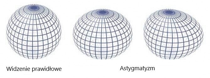 Grafika przedstawia porównanie widzenia osoby o wzroku prawidłowym i osoby z astygmatyzmem. Z lewej wyraźna, prawidłowa grafika przedstawiająca kulę skonstruowaną z linii. Z prawej strony dwa przykłady zaburzeń widzenia tego obiektu u astygmatyka. Jeden obiekt jest spłaszczony, drugi wykrzywiony.
