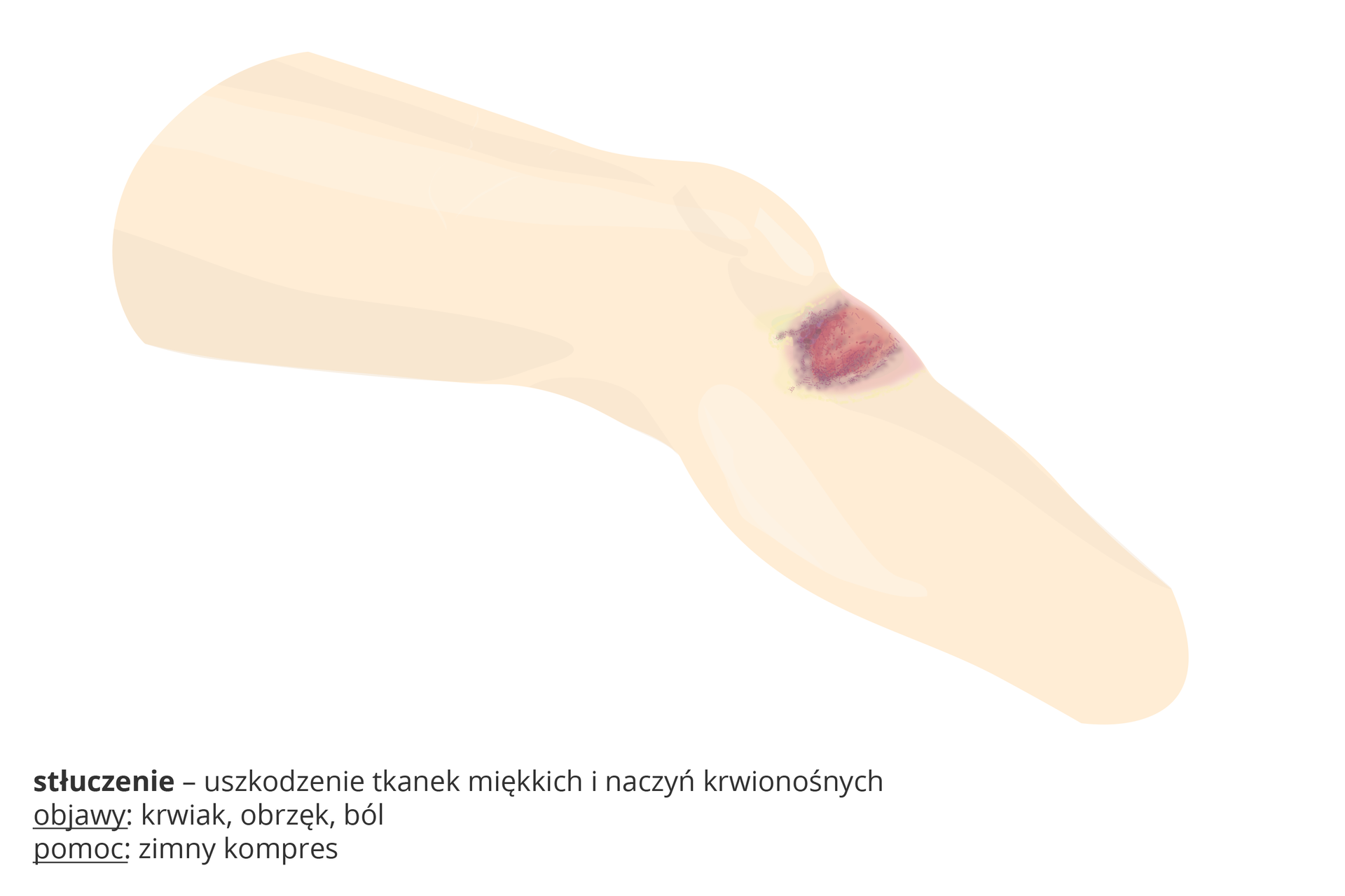 Ilustracja przedstawia schematycznie różowy fragment nogi z czerwono – fioletową plamą pod kolanem. To stłuczenie, czyli uszkodzenie tkanek miękkich i naczyń krwionośnych. Objawy: krwiak, obrzęk, ból. Pomoc: zimny kompres.